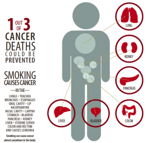 1 out of 3 Cancer Deaths Could be Prevented, Smoking can cause cancer in almost ever part of the human body.